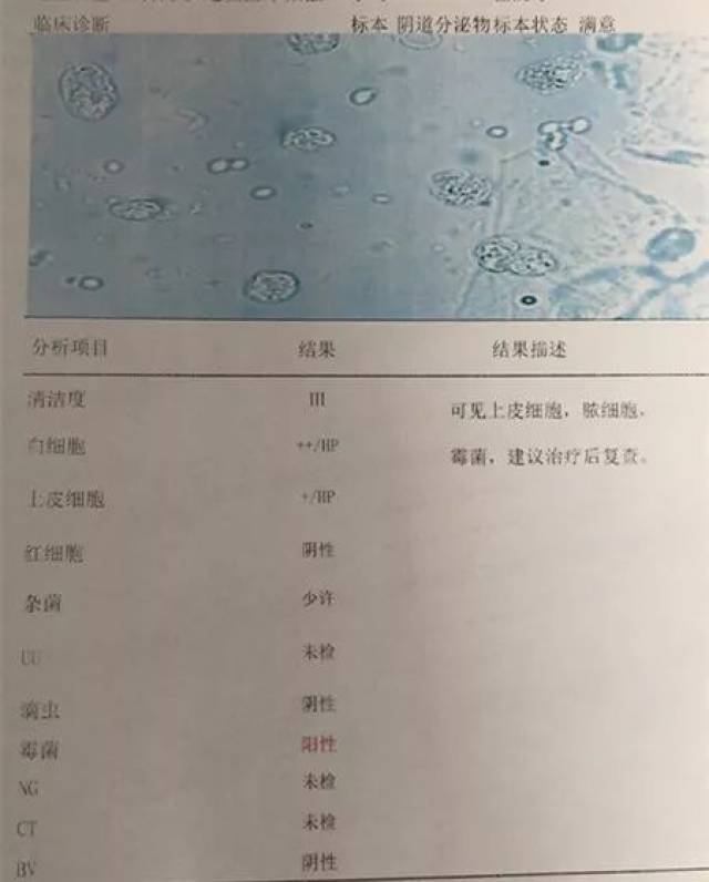 妇科检查报告单怎么看这里教您看
