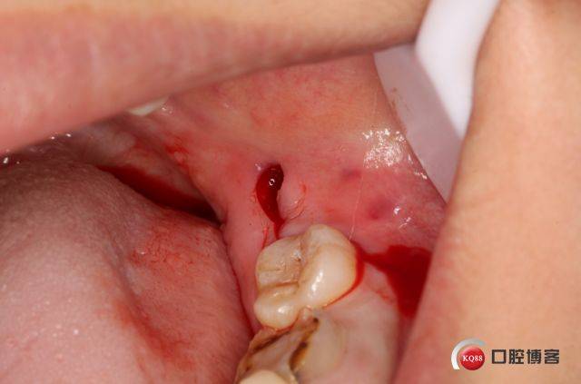 左下水平骨埋伏伴含牙囊肿智齿拔除