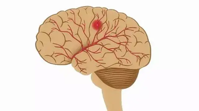 中风,又叫脑卒中或脑血管意外,它是一组以脑部缺血及出血性损伤症状为