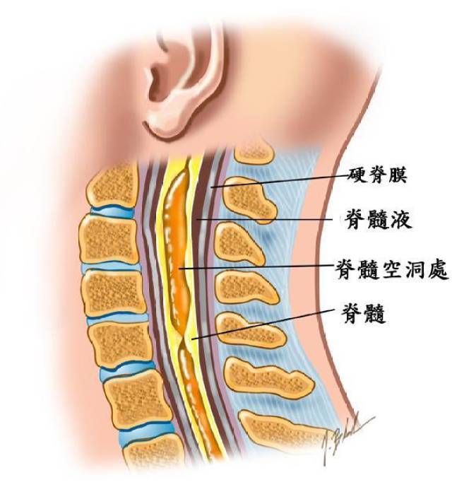 脊髓空洞對人體的幾大危害!專家指導你如何治療