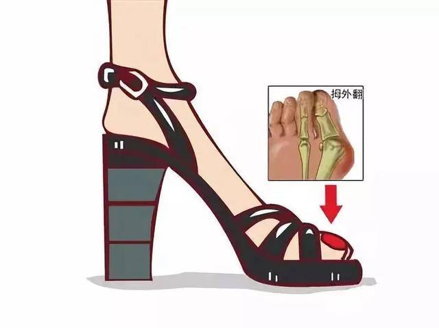 脚变成这样都是高跟鞋惹的祸?