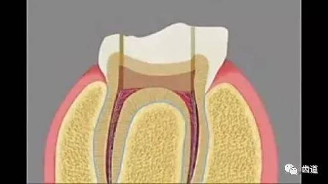 【口腔技能】詳解恆牙髓腔解剖特點及開髓方法