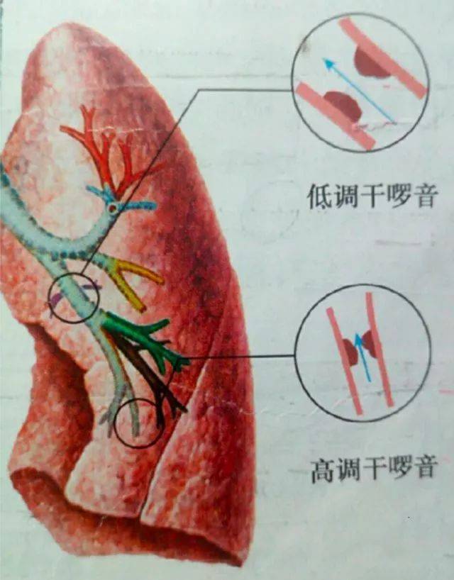 湿啰音、干啰音分不清?3 张图帮你搞定!