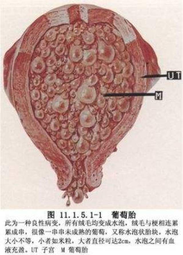 葡萄胎恐怖图片生下图片