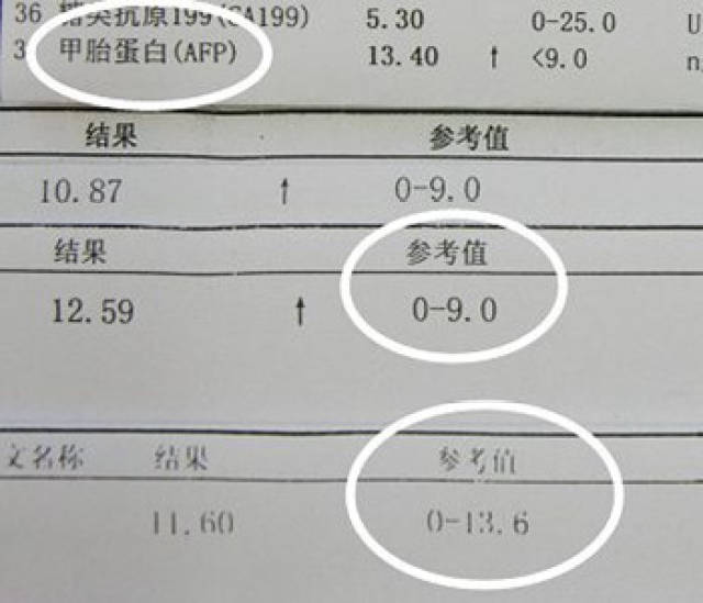 20微克(即≤20μg/l)为正常值,如果甲胎蛋白升高到每升血400微克以上