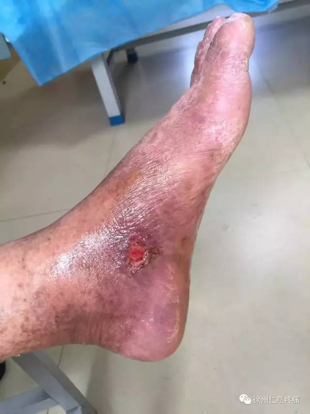血管闭塞性脉管炎,在外院治疗症状时轻时重,三月前出现右下肢局部溃疡