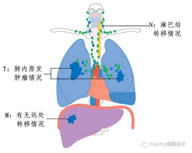 史上最全的肺癌科普知識(必藏)