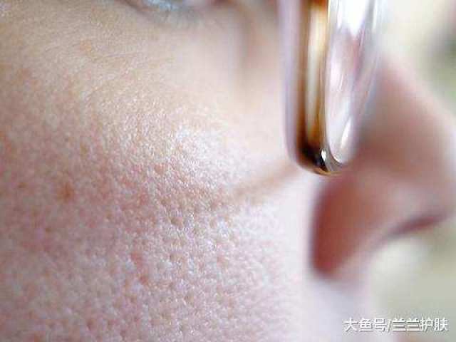 氧化皮脂给皮肤带来负担,导致毛孔变黑等毛孔问题.