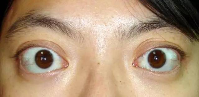 华西论健 | 眼睛又突又大 警惕是你有病