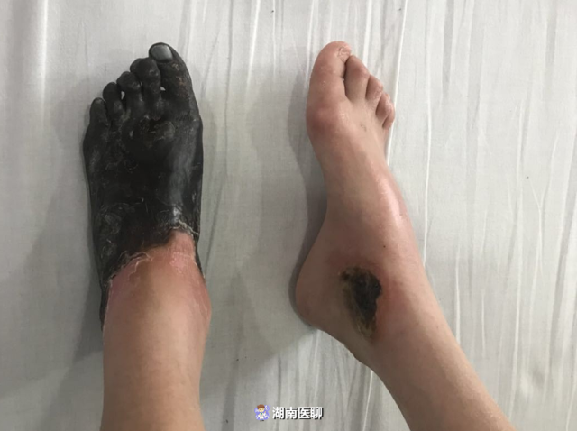 湘妹子體弱多病僅重46斤,整隻左腳發黑像穿