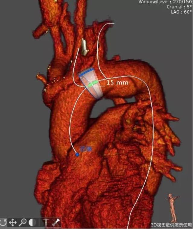 主动脉夹层三维重建图图片