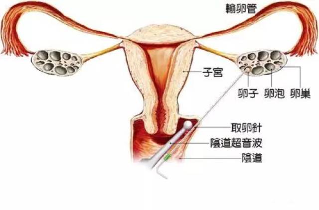 后穹窿穿刺步骤图解图片