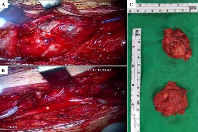尤文肉瘤早期症状图片图片