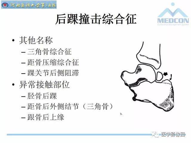 踝关节撞击综合征 搜狐网