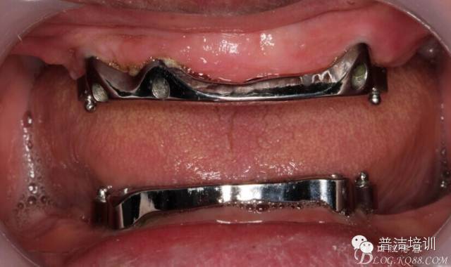 【病例分享】种植修复之杆卡附着体覆盖义齿修复