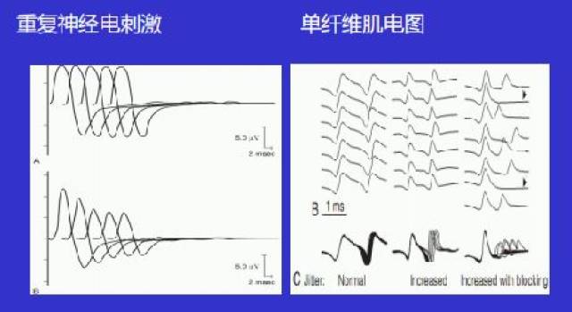 面神经肌电图图解图片