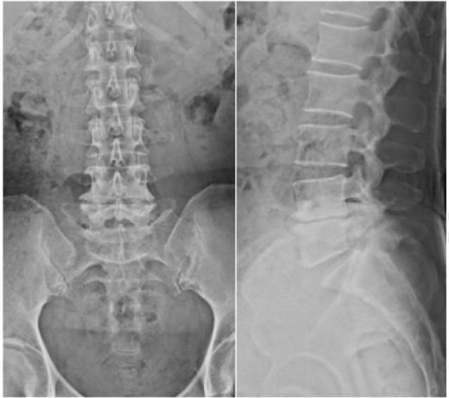 x线平片显示l5-s1椎体峡部裂和i级腰椎滑脱,l4-l5椎间盘间隙减小.