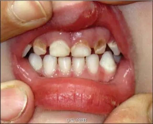 儿童牙齿片子吓人图片