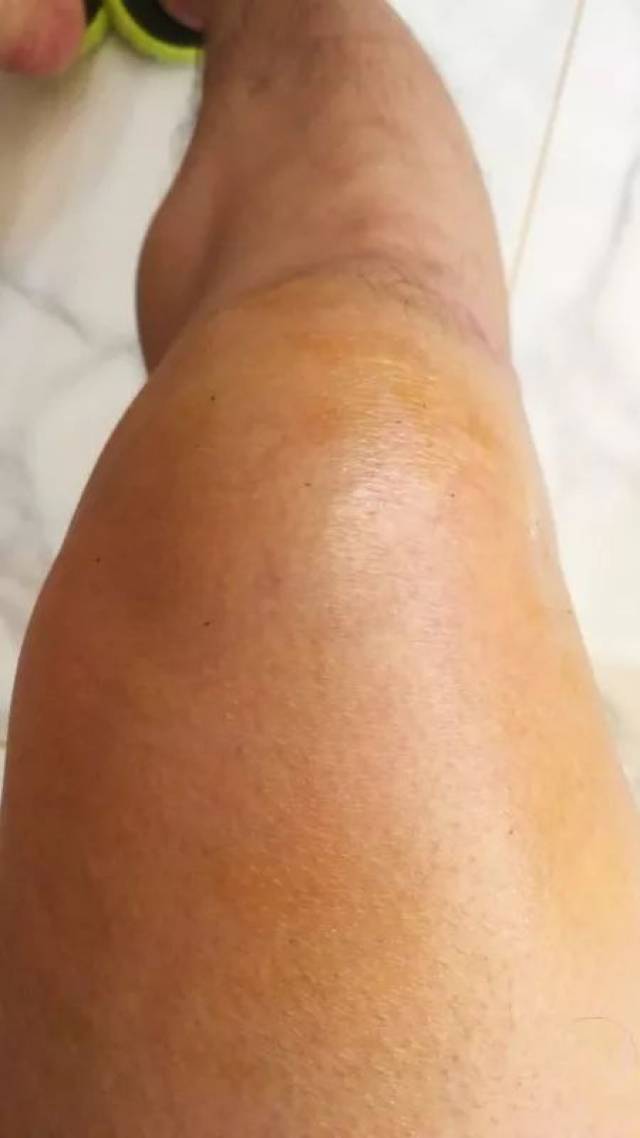 附院医生顾不得自己受伤的腿,病人成功抢救,而自己的腿却