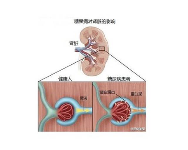 肾脏病人的症状 肾病是什么原因引起的 肾脏病人的饮食