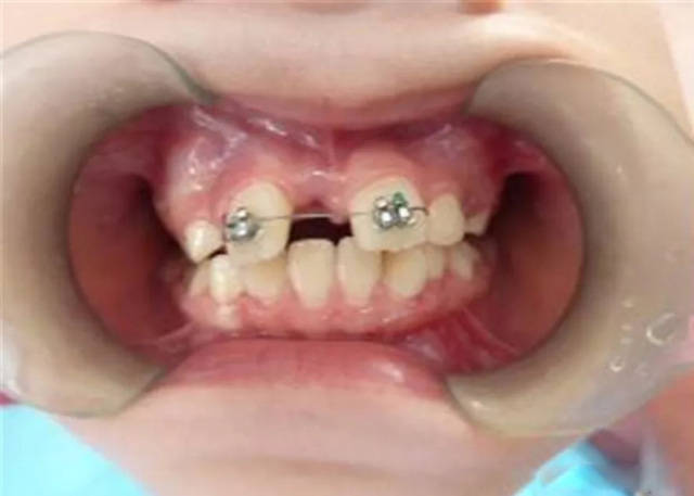 你是否已经错过了孩子矫正牙齿的最佳时间?
