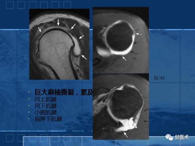 肩关节横断ct解剖图图片