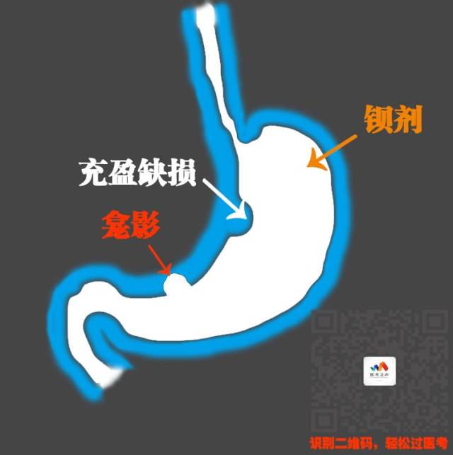 性溃疡 消化性溃疡 常考的就是胃溃疡 因为十二指肠很薄 一般没有龛影