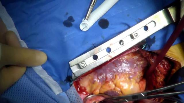 8,主动脉人造血管吻合