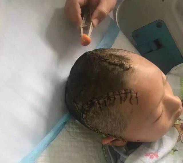 吴江一男孩在家被子弹击中脑袋!急需二次开颅术,求扩散