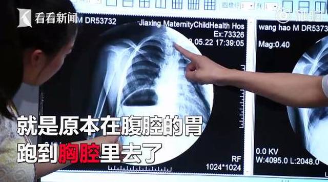 7岁男童每顿饭只能吃三口,医院检查发现胃不见了