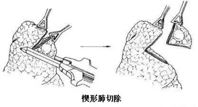 肺楔形切除术示意图图片