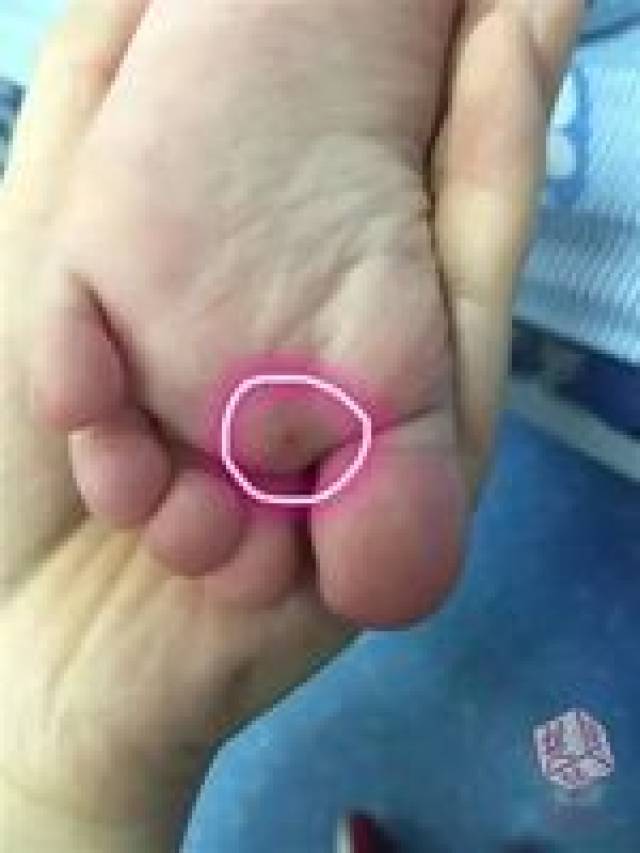 卫生间用水冲洗了血迹,洗完后发现,女儿的脚上有一处像针眼一般的小孔