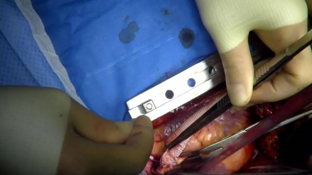 白色的是,连接在主动脉上的人造血管.红色的是,左房引流管.