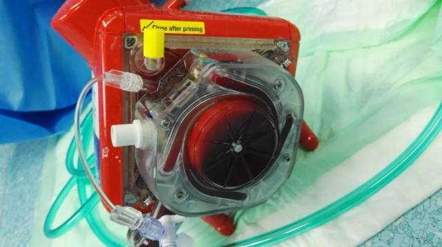 看一下撤除下来的人造肺(氧合器). 长的像肺吗?