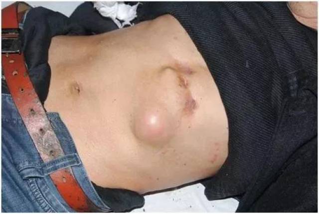 骨结核脓肿代表着什么?是很严重的一种现象吗