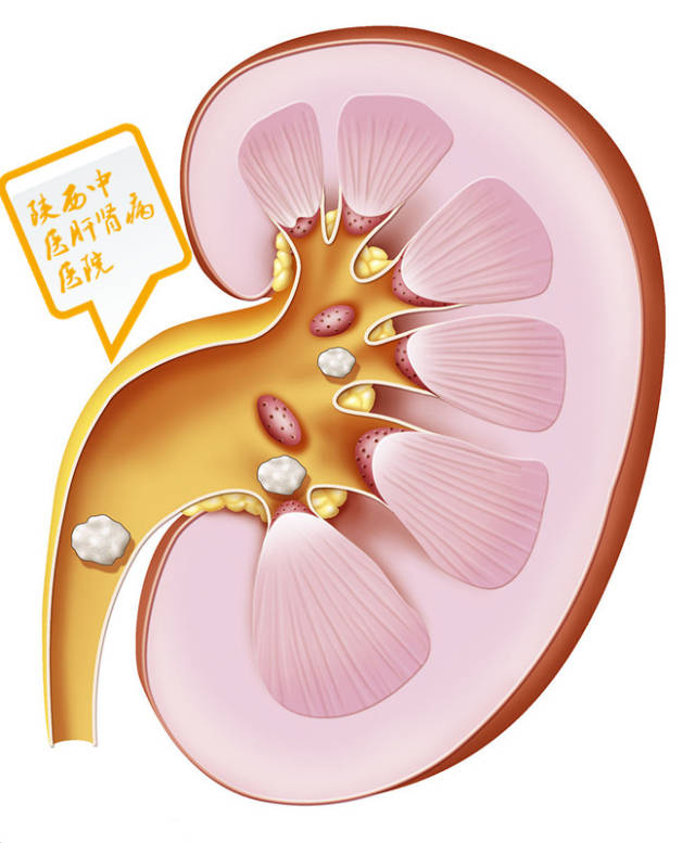 天气变热易患肾结石吗?
