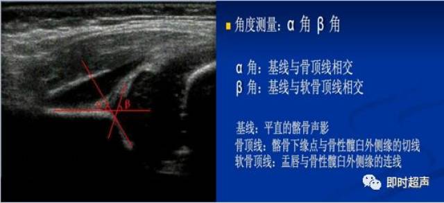 小儿髋关节疾病的超声诊断