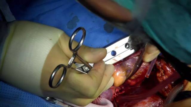 白色的是,连接在主动脉上的人造血管.红色的是,左房引流管.