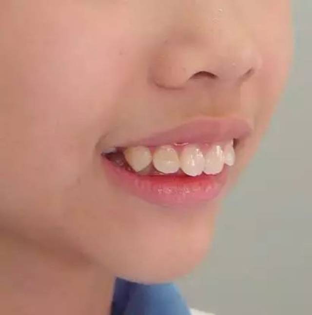 12岁前必须处理的牙颌畸形,等12岁以后再矫正就晚了!