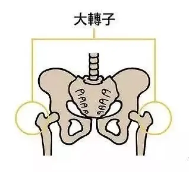 假胯其实是股骨大转子突出, 股骨与身体中心线偏离角度较大