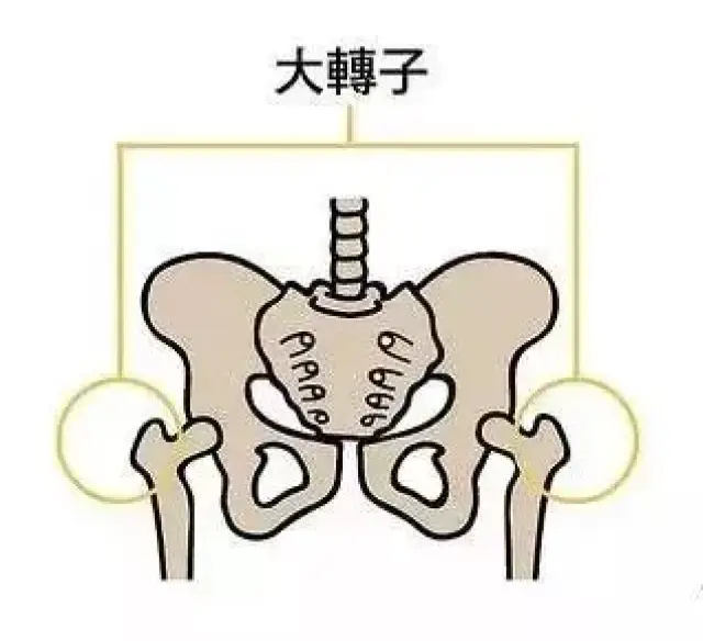 假胯其实是股骨大转子突出 股骨与身体中心线偏离角度较大.