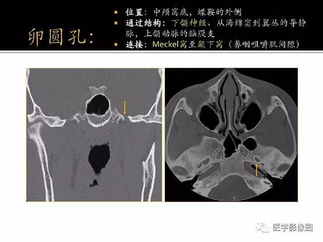 別再說難了,手把手教您學鼻腔鼻竇及顱底ct影像解剖