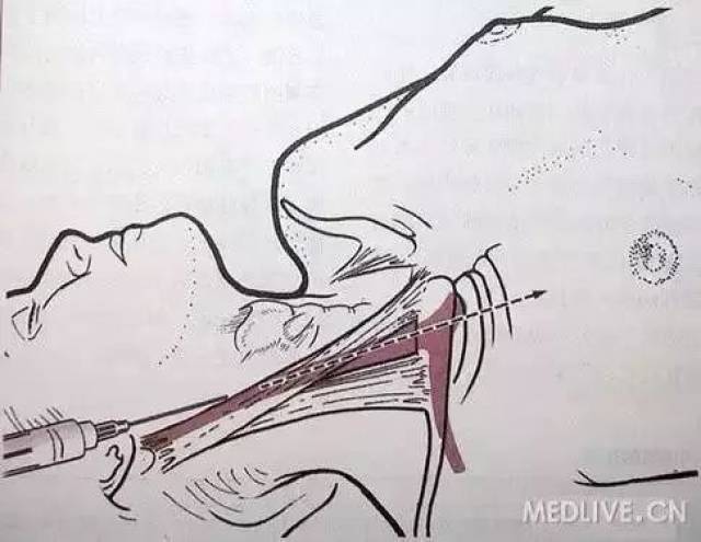 颈内静脉注入头臂静脉图片