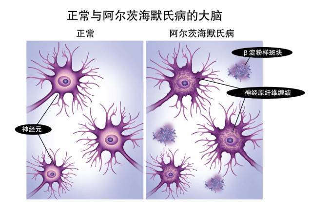 几乎所有阿尔茨海默病患者的大脑组织 有大量-淀粉样蛋白 的