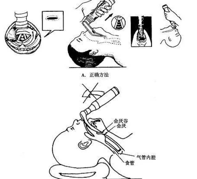 电子喉镜过程图片