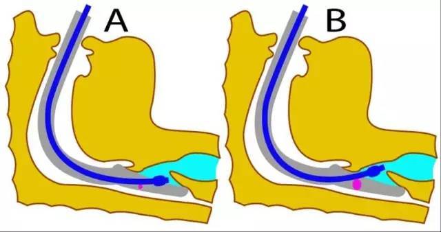 【麻醉琅琊榜】未尽的故事:archie brain和他的喉罩