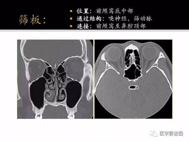 別再說難了,手把手教您學鼻腔鼻竇及顱底ct影像解剖