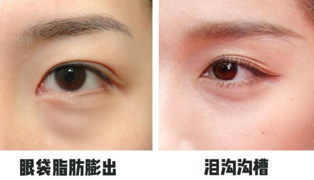 肌肤老化,松弛,皮下脂肪下移到眼周, 眶隔脂肪突出,出现眼袋,泪沟造成