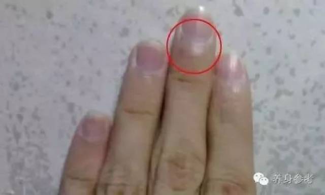 白血病指甲变化图图片