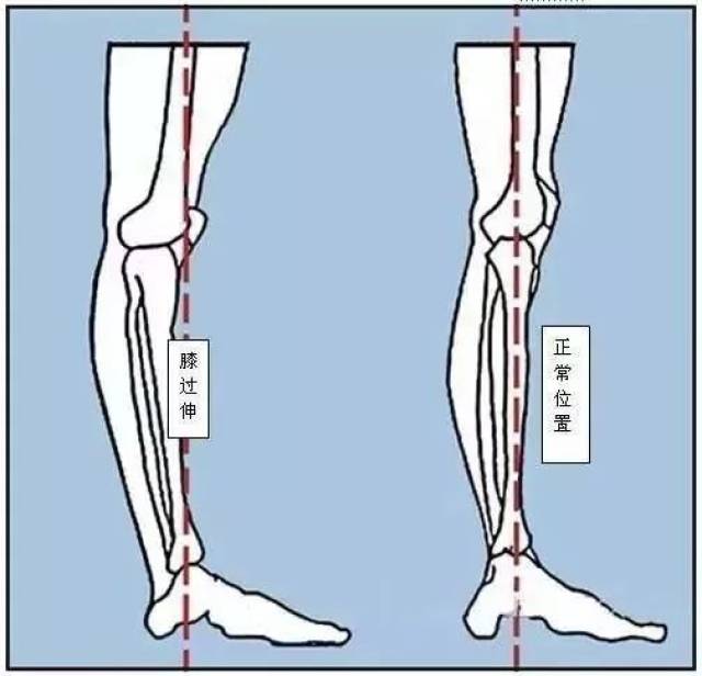 膝反张是什么原因？